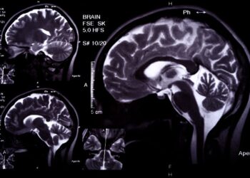 Recovering Compensation for Traumatic Brain Injuries in Charlotte, NC