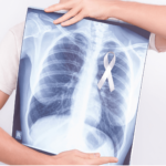 Person holding chest x-ray showing lung cancer