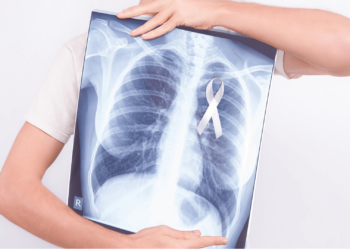 Person holding chest x-ray showing lung cancer